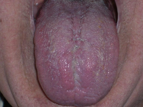 Zungendiagnose - Grundkurs - auf Triviar